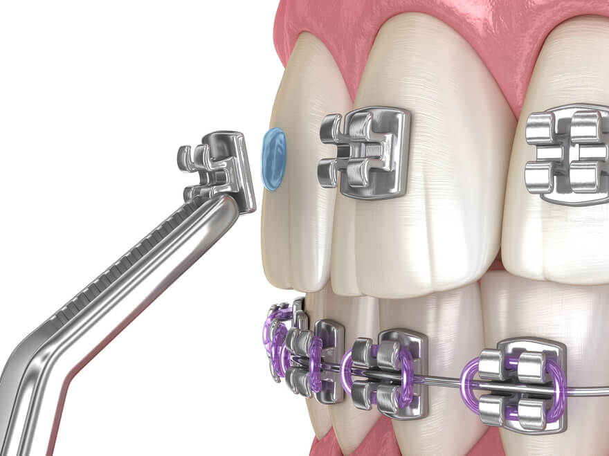 Braces bracket online colors